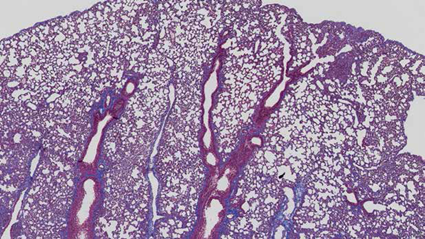 Cook and his team found that blocking the protein interleukin-11 can prevent and reverse fibrosis in the lung