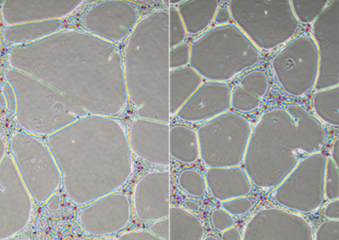 Side by side pictures of cells as seen under the microscope. The left side shows endothelial cells from a healthy individual while the right side shows those from a patient with Alzheimer&#39;s disease