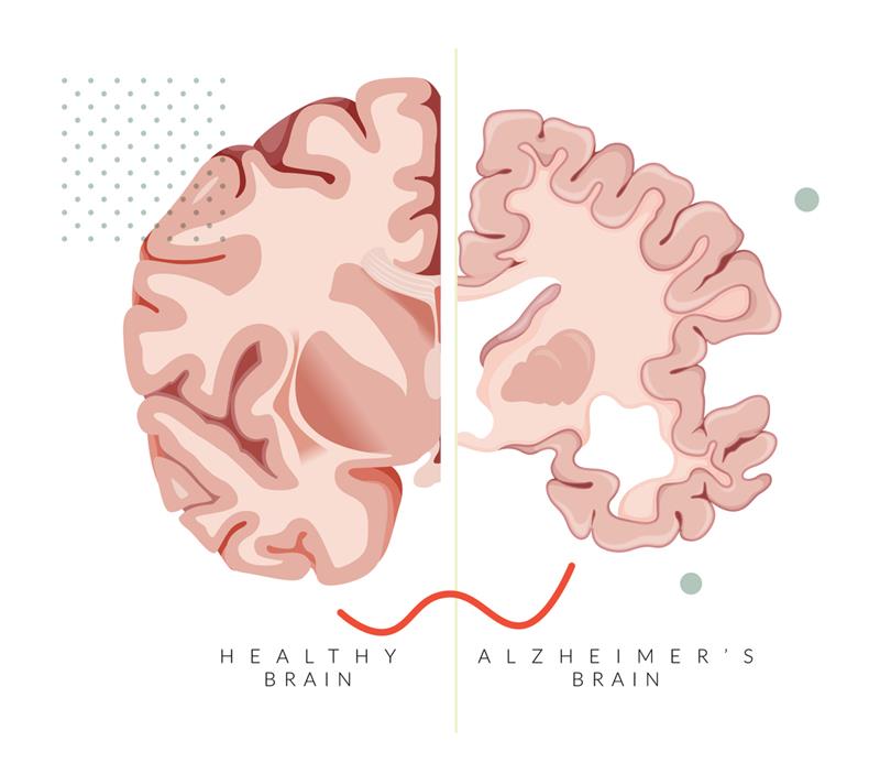 An illustration showcasing the extent of shrinkage in a diseased brain // Credit: iStock.com / Shivendu Jauhari