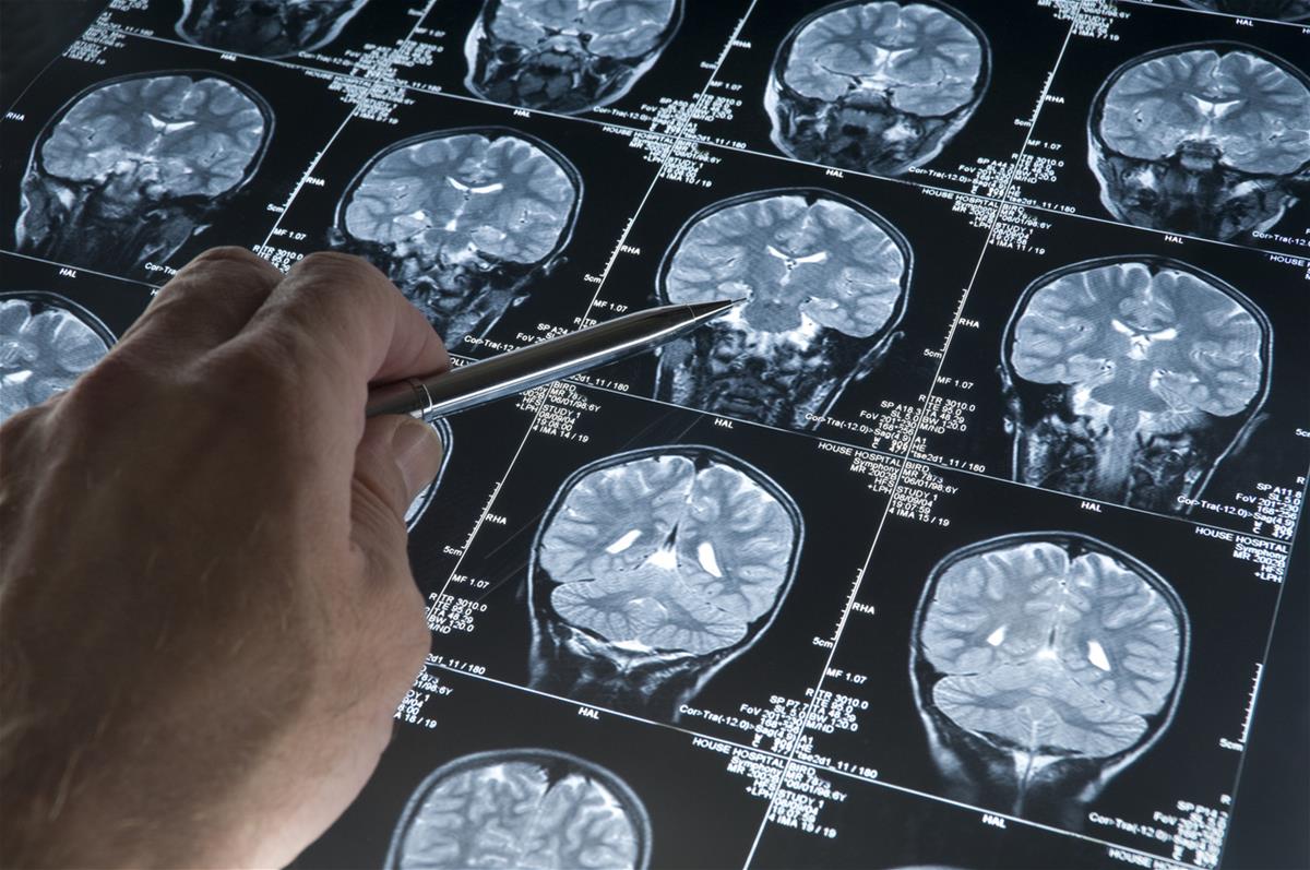 At the clinic, magnetic resonance imaging scans offer clinicians like Ng the opportunity to examine changes in a patient’s brain // Credit: iStock.com / haydenbird