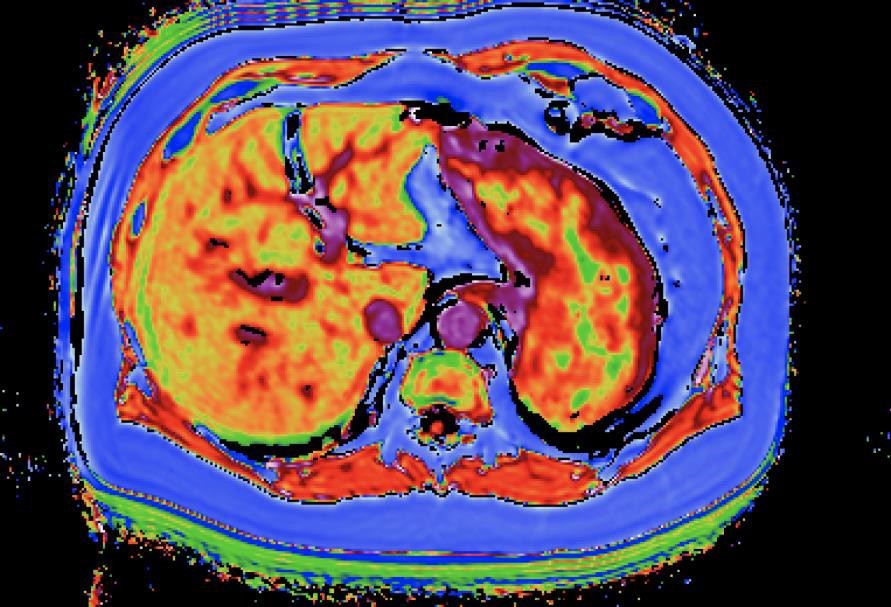 MRI imaging of fibrotic and fatty liver