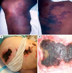 Calcific uremic arteriolopathy